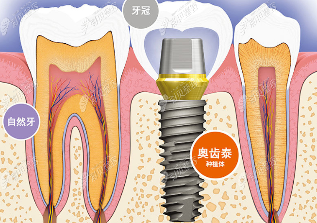 韩国奥齿泰种植牙示意图