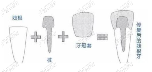 桩核冠修复过程