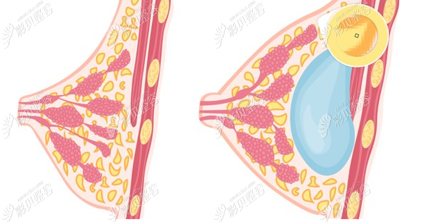 凯莱整形胸部术前后对比图