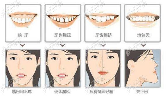 微齿性龅牙加深覆盖戴隐适美多少钱要看牙齿还有哪些症状