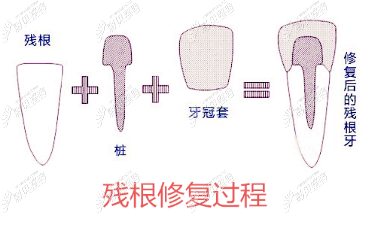桩核冠修复牙缺失的过程