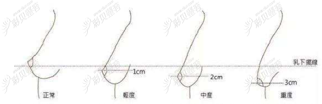 不同的乳房基础 不同的乳房基础