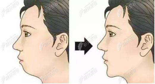 骨性双颌前突、凸嘴牙齿内收6mm费用