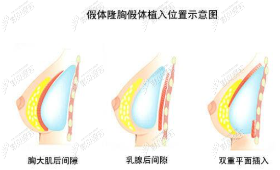 假体植入位置示意图 假体植入位置示意图