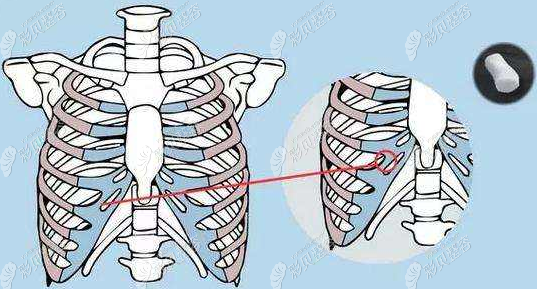 昆明梦想整形做自体肋软骨隆鼻怎么样 昆明梦想整形做自体肋软骨隆鼻怎么样