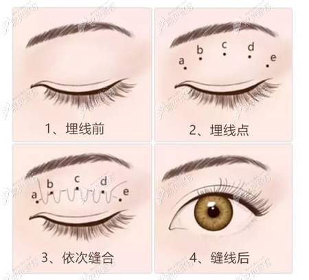 张冠勋医生做埋线双眼皮过程