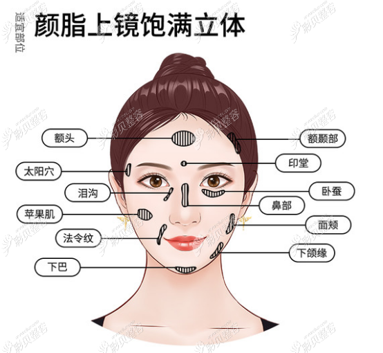 自体脂肪可以填充的部位