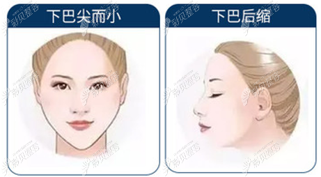 做下巴截骨前移手术价格和自身病症有关