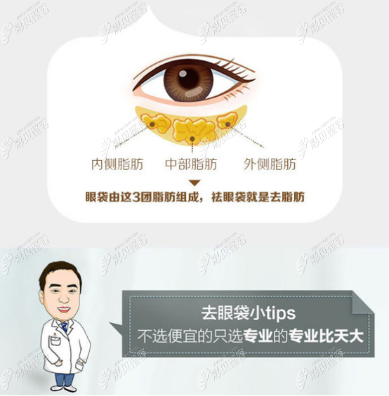 祛眼袋手术选对医生很关键