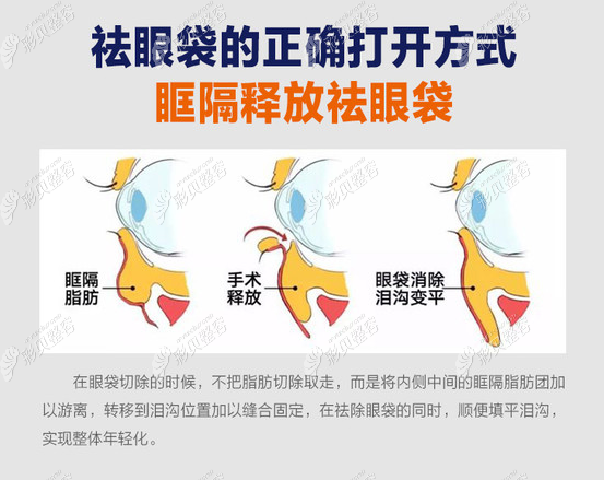 眶隔脂肪释放祛眼袋方法