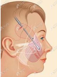 V美减龄提升切口示意图 V美减龄提升切口示意图