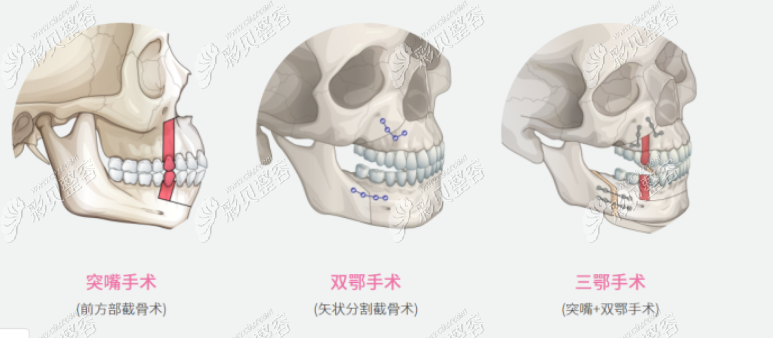 双颚手术部位图解