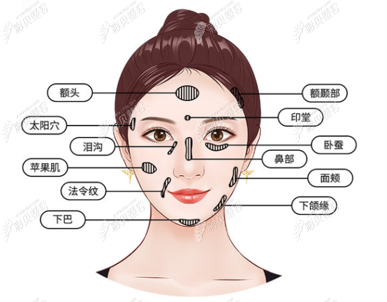 玻尿酸可以填充哪些部位