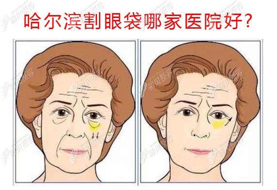 哈尔滨去眼袋技术好的医院推荐了擅长超声眼袋消除的医生