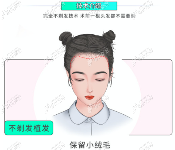 完全不剃发植发技术介绍