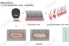 各种植发技术种类的对比分析现在种植头发的技术到底如何