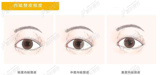 乌鲁木齐华美整形做开眼角手术怎么样