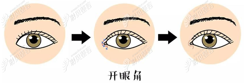 乌鲁木齐哪些医院做开眼角手术好