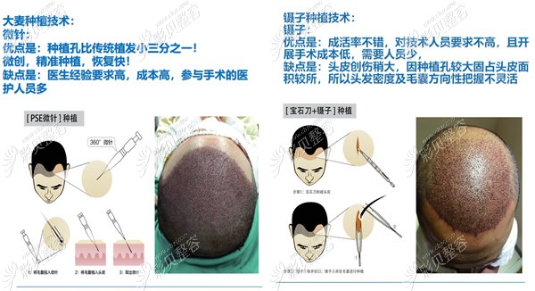 大麦微针植发和传统镊子植发的区别