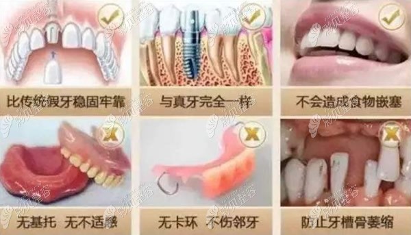 种植牙和活动假牙的区别