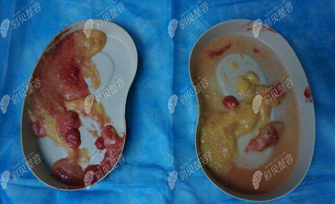 遗漏出的奥美定