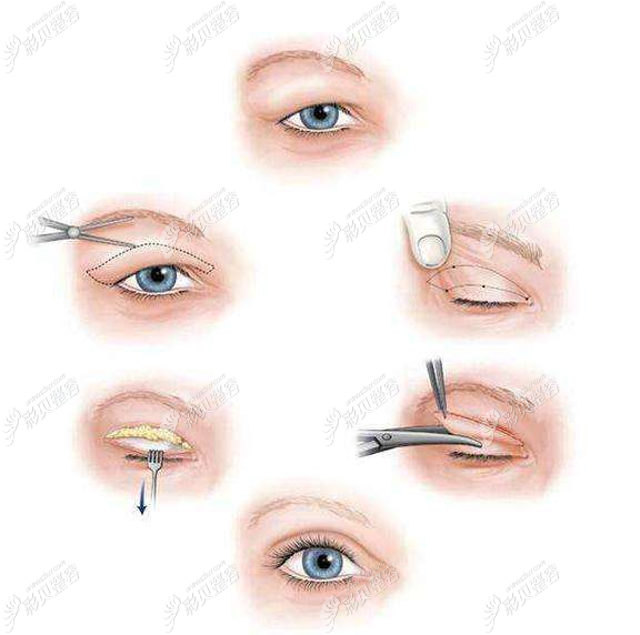割双眼皮手术过程