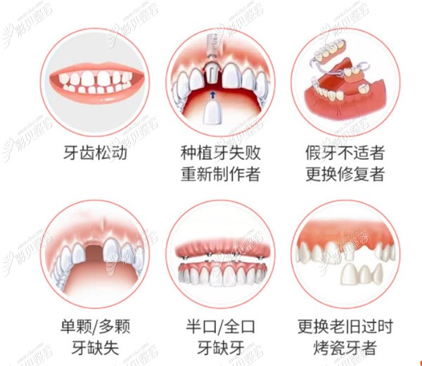 种植牙适合哪些牙齿情况