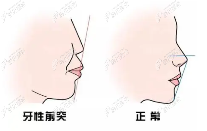 牙性前突和正常人侧面照区别