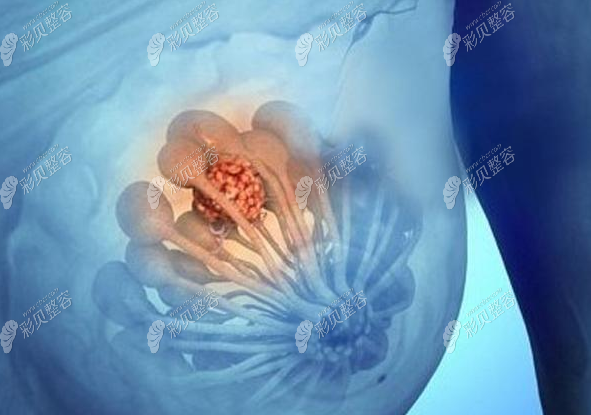 奥美定在胸部的情况