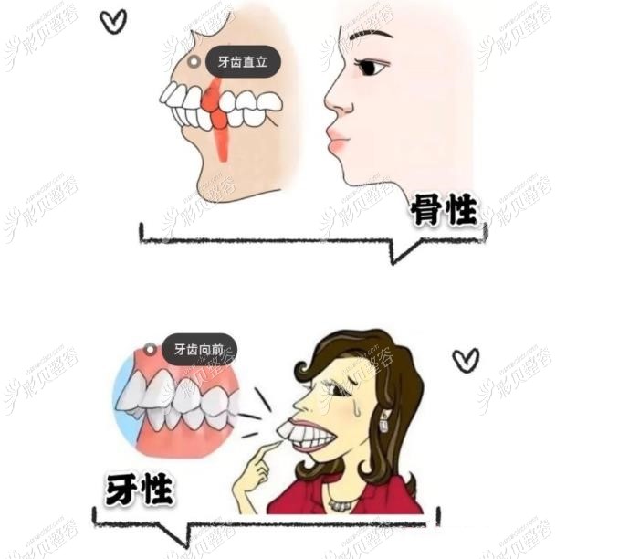 骨性凸嘴和牙性凸嘴图片对比