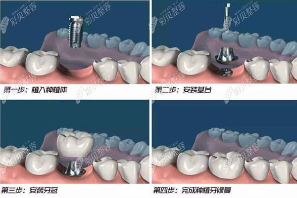 种植牙过程和步骤