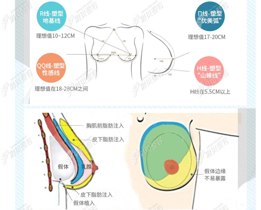 曼托假体隆胸的过程及特点 曼托假体隆胸的过程及特点