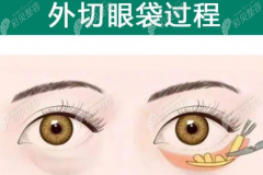 看我在上海华美整形找佀同帅医生做外切祛眼袋手术怎么样