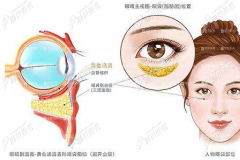 看我在上海华美整形找佀同帅医生做外切祛眼袋手术怎么样
