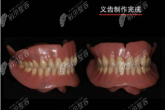 bps吸附性义齿价格里面有全口和上下半口吸附的收费标准
