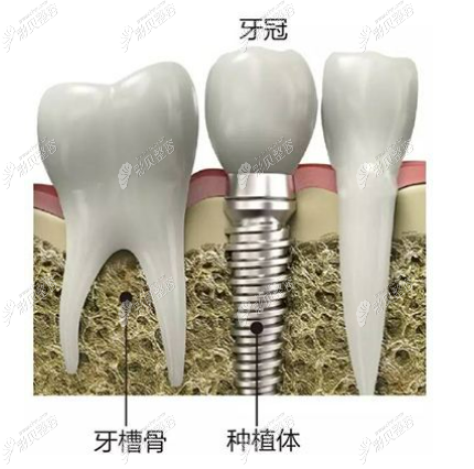 通过种植牙的方式来镶牙的价格表