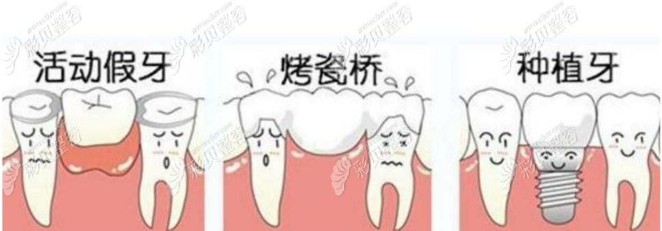 镶牙多少钱一颗2022价格表