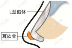 上海做鼻子好的医生排名,看他们做进口硅胶假体隆鼻多少钱
