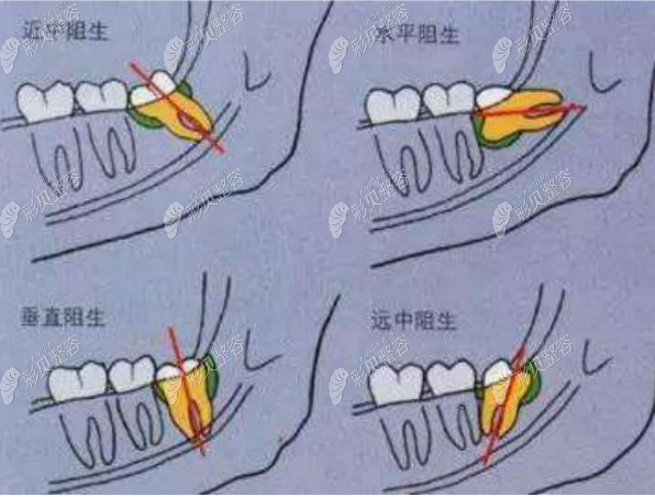 不同位置的智齿拔除价格表