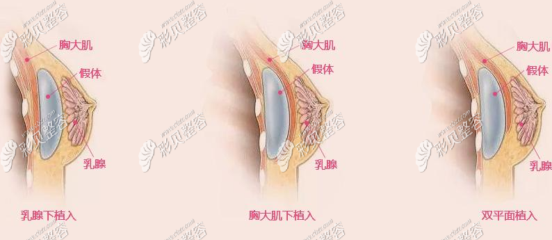 假体隆胸过程