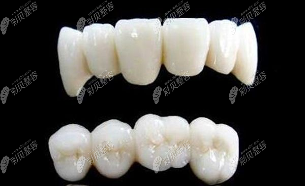 迪瑞dentaldirekt氧化锆全瓷牙怎么样