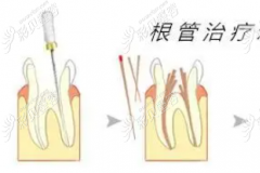 做完根管治疗之后还可以牙齿矫正吗？根管后正畸能带牙冠