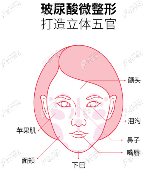 玻尿酸可以填充面部哪些问题