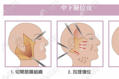 深圳这家医院能做脸部拉皮手术，微创小切口除皱还挺靠谱