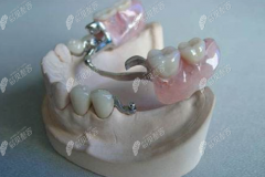 连着两颗大牙缺失除了种牙还有什么办法，能装隐形义齿吗