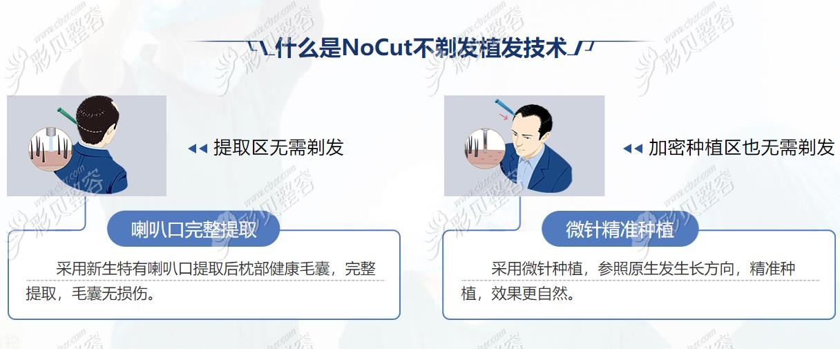 不剃发植发技术种植4000单位头发多少钱
