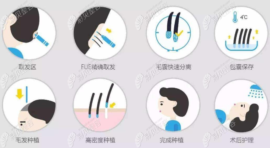 植发过程图解