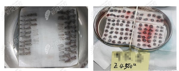 正规医院和不正规医院提取的毛囊对比照