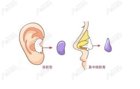 深圳鹏程刘冰做鼻综合技术怎么样