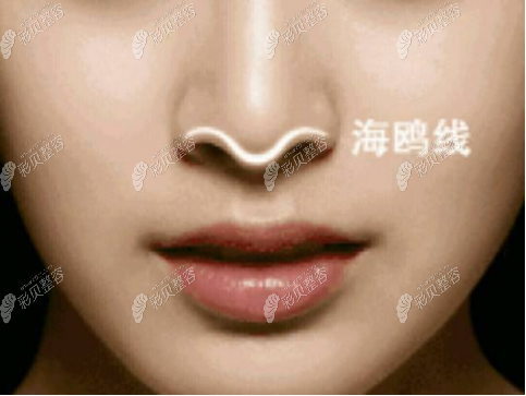 什么是鼻子的海鸥线